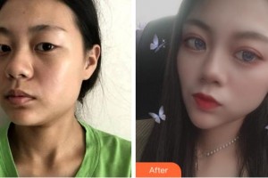 宜賓天使之翼醫(yī)療美容整形門(mén)診部周洪超整形價(jià)格表附眼部綜合案例展示