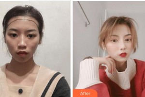 宜賓天使之翼醫(yī)療美容整形門(mén)診部王光斌整形價(jià)格表附種植發(fā)際線案例展示