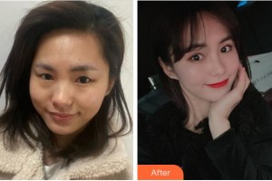 廣安市人民醫(yī)院燒傷整形美容科李凡整形價(jià)格表附眼部綜合案例展示