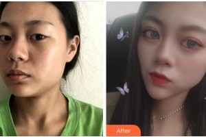 廣安阿藍(lán)醫(yī)院醫(yī)療美容科王靜整形價(jià)格表附眼部綜合案例展示