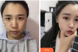 達(dá)州仁美醫(yī)學(xué)整形美容門(mén)診部周院長(zhǎng)整形價(jià)格表附眼部綜合案例展示