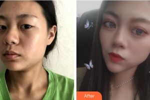 達(dá)州仁美醫(yī)學(xué)整形美容門(mén)診部周奇濤整形價(jià)格表附眼部綜合案例展示