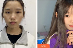 達(dá)州海博醫(yī)學(xué)美容醫(yī)院歐海波整形價(jià)格表附激光祛斑案例展示