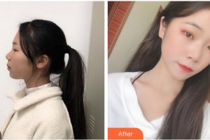 達(dá)州市中心醫(yī)院醫(yī)學(xué)美容中心李磊整形價(jià)格表附光子嫩膚案例展示