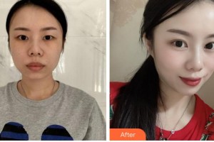 達(dá)州愛(ài)爾博視醫(yī)院吳松整形價(jià)格表附眼部綜合案例展示