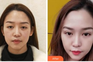 達(dá)州愛(ài)爾博視醫(yī)院鄒林整形價(jià)格表附眶隔脂肪釋放案例展示