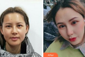 達(dá)州愛(ài)爾博視醫(yī)院胡建斌整形價(jià)格表附上瞼提肌案例展示