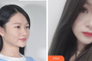 達(dá)州愛(ài)爾博視醫(yī)院王錚整形價(jià)格表附眼部綜合案例展示