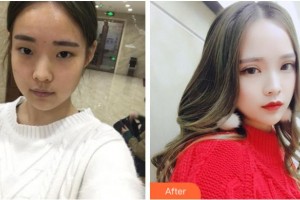 達(dá)州市中西醫(yī)結(jié)合醫(yī)院眼科甘國(guó)菊整形價(jià)格表附切開(kāi)雙眼皮案例展示