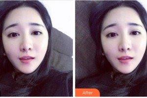 達(dá)州愛(ài)瑞眼科醫(yī)院匡毅整形價(jià)格表附上眼瞼去脂案例展示