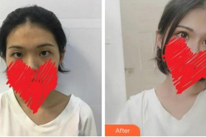 達(dá)州市中西醫(yī)結(jié)合醫(yī)院眼科劉進(jìn)整形價(jià)格表附切開(kāi)雙眼皮案例展示