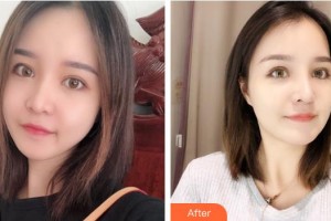 湖南省人民醫(yī)院整形激光美容中心李高峰整形價(jià)格表附面部吸脂案例展示