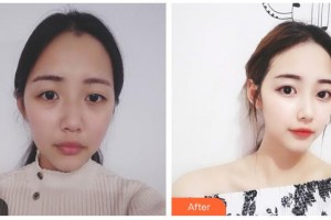 武警湖南總隊(duì)醫(yī)院整形美容中心高衛(wèi)先整形價(jià)格表附埋線提升案例展示