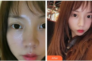 湖南省人民醫(yī)院整形激光美容中心李波整形價(jià)格表附熱瑪吉案例展示