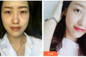 湖南省人民醫(yī)院整形激光美容中心吳東輝整形價(jià)格表附鐳射凈膚案例展示