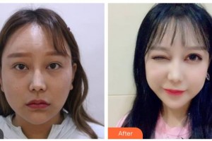 湖南省人民醫(yī)院整形激光美容中心羅滔整形價(jià)格表附眼部綜合案例展示