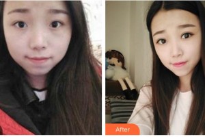 湖南省中醫(yī)藥研究院附屬醫(yī)院醫(yī)學(xué)美容中心何高洲整形價(jià)格表附切開(kāi)雙眼皮案例展示