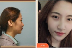 湖南省南華大學(xué)附一醫(yī)院激光美容中心段非交整形價(jià)格表附水氧活膚案例展示