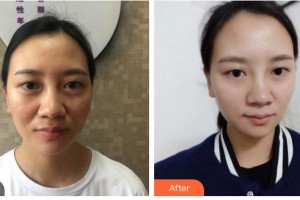 湖南省南華大學(xué)附一醫(yī)院激光美容中心譚善彰 整形價(jià)格表附埋線提升案例展示