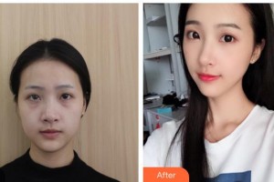 湖南中醫(yī)藥大學(xué)第一附屬醫(yī)院整形美容中心楊文彪整形價(jià)格表附埋線提升案例展示