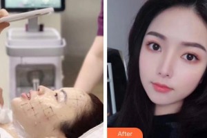 湖南中醫(yī)藥大學(xué)第一附屬醫(yī)院整形美容中心辛衛(wèi)平整形價(jià)格表附熱瑪吉案例展示