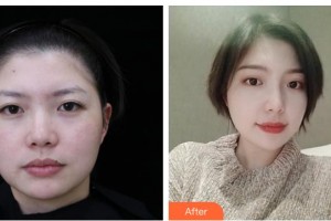 湖南中醫(yī)藥大學(xué)第一附屬醫(yī)院整形美容中心李定文整形價(jià)格表附熱瑪吉案例展示