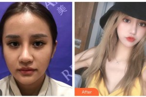 湖南省第二人民醫(yī)院整形美容中心朱飛玲整形價(jià)格表附熱瑪吉案例展示