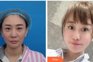 湖南省第二人民醫(yī)院整形美容中心宋金榮整形價(jià)格表附埋線提升案例展示