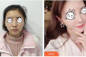 湖南省第二人民醫(yī)院整形美容中心王榮基整形價格表附光子嫩膚案例展示