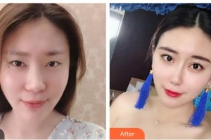 湖南美研醫(yī)療美容門(mén)診部冷美林整形價(jià)格表附鼻部綜合案例展示