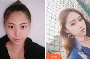 湖南愛(ài)薇爾醫(yī)療美容門(mén)診部周瑞春整形價(jià)格表附鼻部綜合案例展示