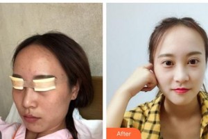 湖南博雅眼科醫(yī)院王成業(yè)整形價(jià)格表附切開(kāi)雙眼皮案例展示