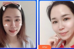 湖南博雅眼科醫(yī)院姜德詠整形價(jià)格表附眼部綜合案例展示