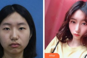 湖南博雅眼科醫(yī)院李曦整形價格表附上瞼提肌案例展示