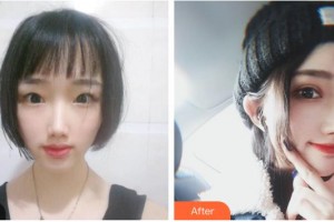 湖南博雅眼科醫(yī)院胡蓉整形價格表附切開雙眼皮案例展示