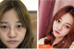 湖南博雅眼科醫(yī)院段智博整形價格表附切開雙眼皮案例展示