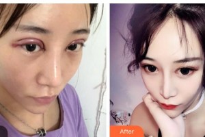 湖南省直中醫(yī)醫(yī)院眼科代敏整形價格表附切開雙眼皮案例展示