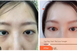 湖南省直中醫(yī)醫(yī)院眼科肖哲夫整形價格表附內切祛眼袋案例展示