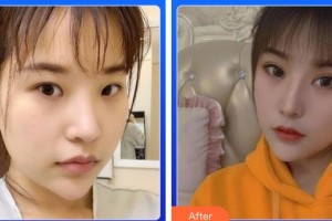 湖南醫(yī)藥學院第一附屬醫(yī)院醫(yī)療美容科張雪梅整形價格表附切開雙眼皮案例展示