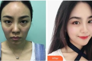 株洲嘉美醫(yī)療整形美容診所黃敏健整形價格表附埋線提升案例展示