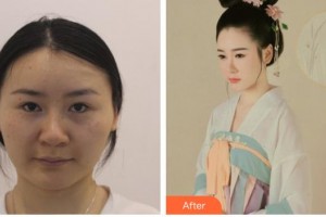 株洲中雅醫(yī)療美容門診部蔣松林整形價格表附埋線提升案例展示