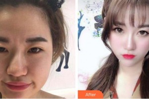 株洲中雅醫(yī)療美容門診部文學海整形價格表附埋線提升案例展示