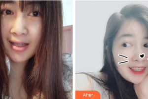 深圳口腔診所王杰整形價(jià)格表附自鎖矯正案例展示