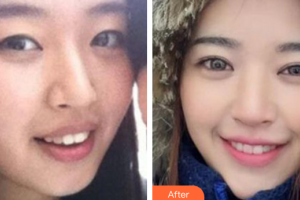 深圳口腔診所溫家強(qiáng)整形價(jià)格表附牙齒隱形矯正案例展示