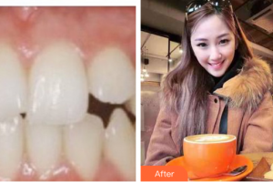 深圳口腔診所曾翠英整形價(jià)格表附牙齒矯正案例展示