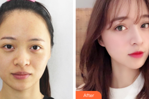 中國(guó)科學(xué)院大學(xué)深圳醫(yī)院醫(yī)療美容科梁大寧整形價(jià)格表附超激光美膚激光祛斑案例展示