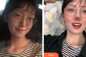 深圳博愛(ài)曙光醫(yī)院高蘇健整形價(jià)格表附金屬托槽矯正案例展示