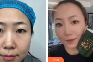 深圳美加美醫(yī)療美容門診部邱斌整形價格表附眼部手術(shù)案例展示