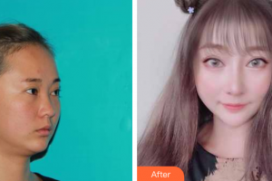 深圳吉美瑞麗斯醫(yī)療美容門診部魯璐整形價格表附肋軟骨隆鼻案例展示