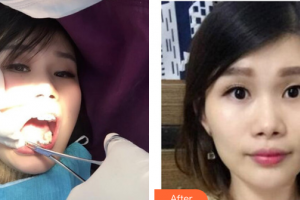 深圳博愛曙光醫(yī)院鐘春根整形價格表附金屬矯正案例展示